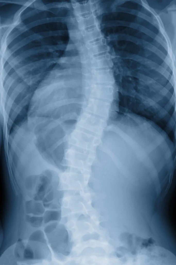 Scoliosis X-Ray